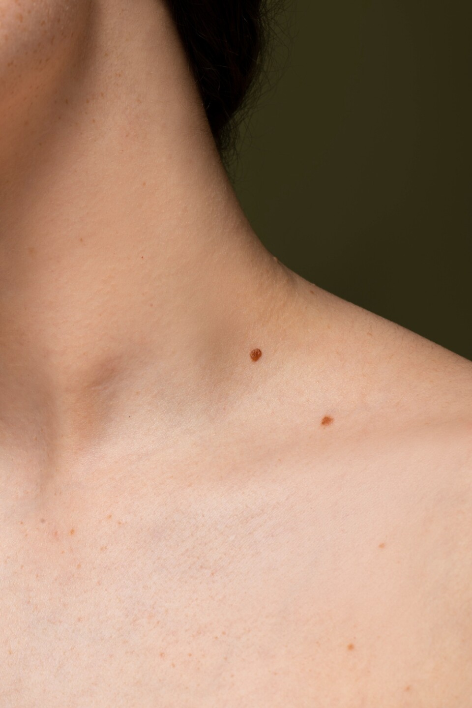 Verruga en el cuello