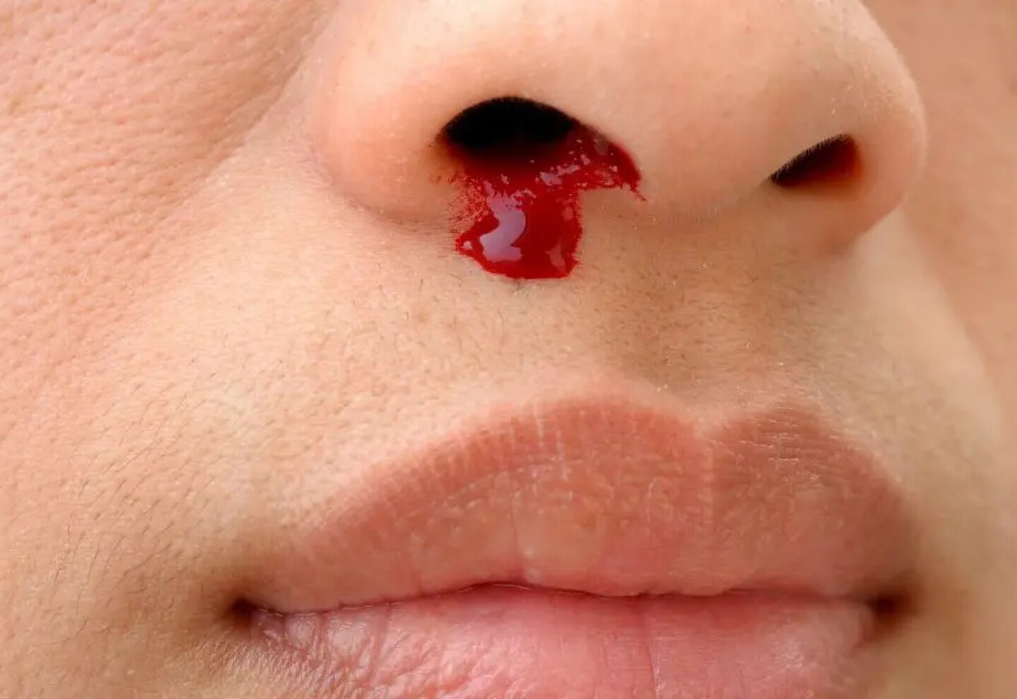 Sangrado de nariz.jpg