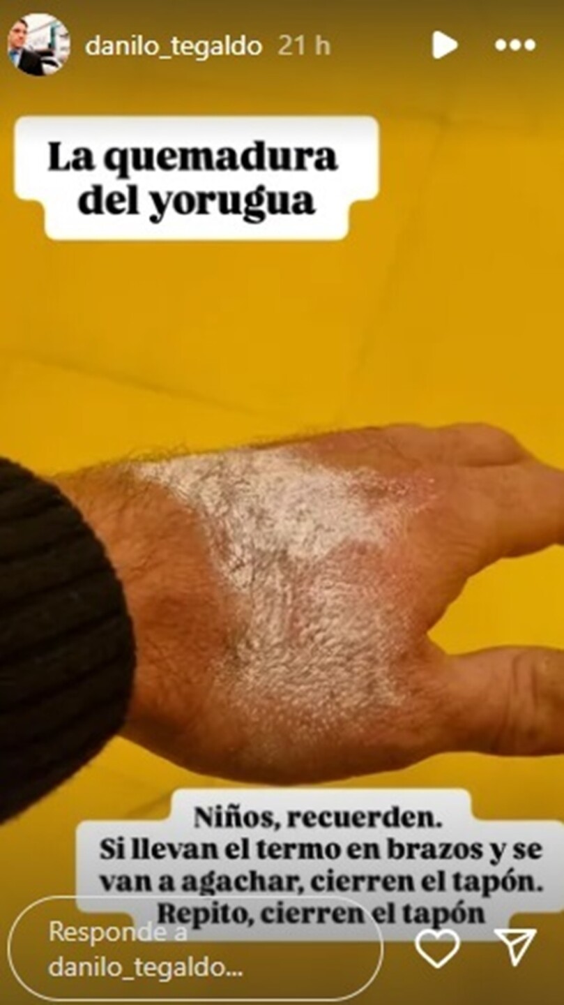 El mensaje y la foto de la quemadura que Danilo Tegaldo compartió en sus redes sociales.