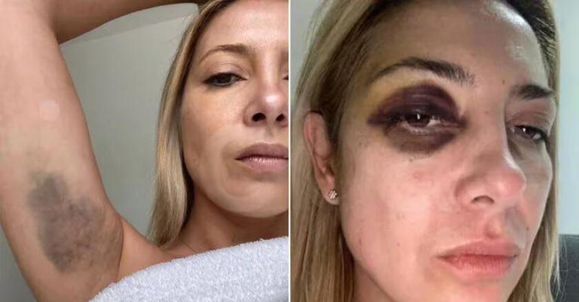 Se divulgaron las fotos de Fabiola Yañez con golpes en la cara y el cuerpo,  tras denuncia a Alberto Fernández - EL PAÍS Uruguay