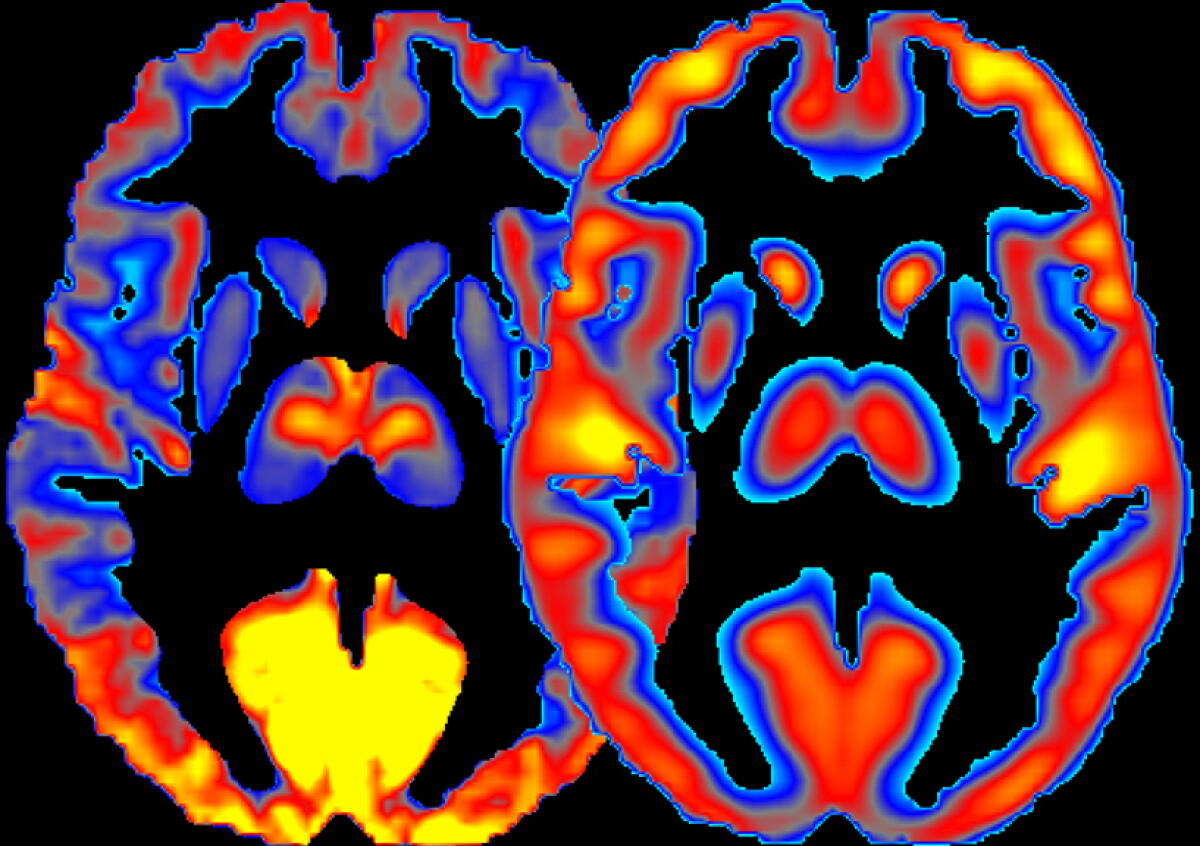 Los grupos de alimentos que la medicina recomienda reducir para evitar la inflamación cerebral y la demencia