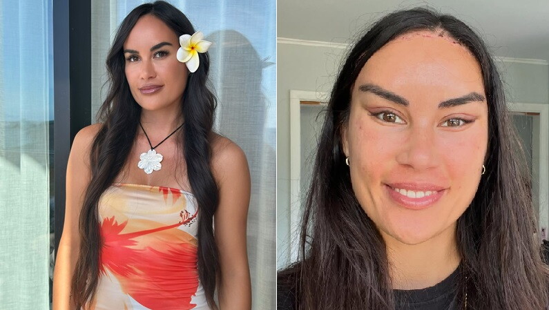 Lourissa Setu antes y después de las operaciones faciales