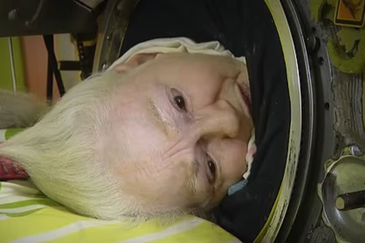 Martha Ann Lillard tenía 78 años y era la última mujer con polio en Estados Unidos