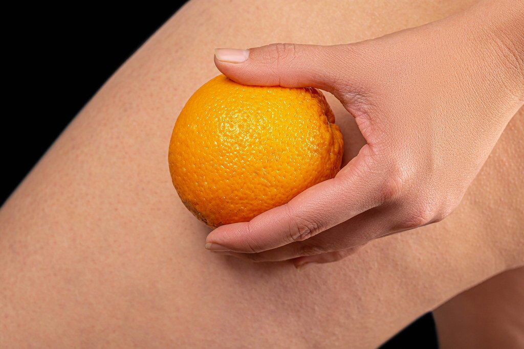 Celulitis.jpg